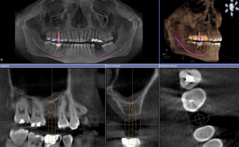 Radiologia tridimensionale Cone Beam 3D