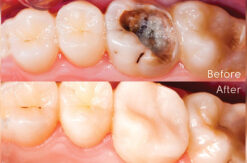 Esempio di otturazione di un molare in odontoiatria conservativa-Studio-odontoiatrico-Zedda-Settimo-San-Pietro