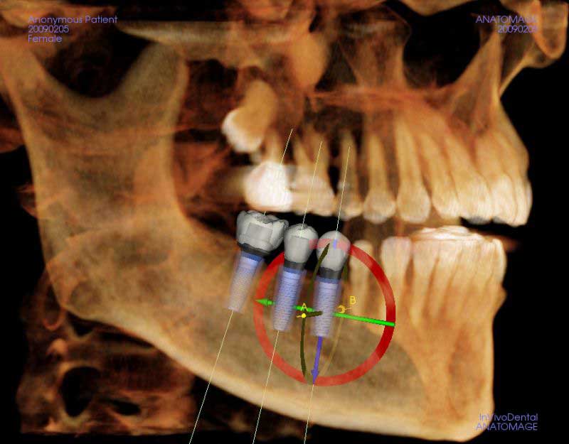 iCat Dental Implant Placement