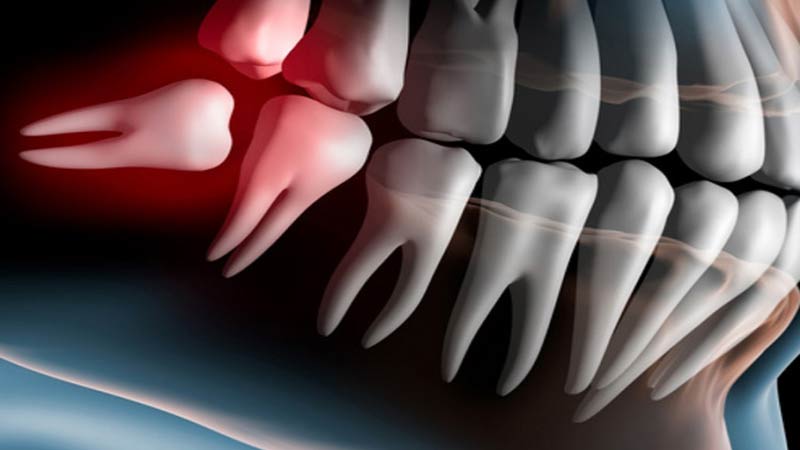 Chirurgia orale: esempio di dente del giudizio da estrarre