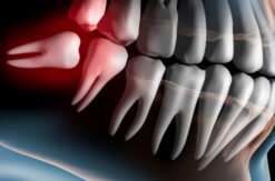 Chirurgia orale: esempio di dente del giudizio da estrarre-Studio-odontoiatrico-Zedda-Settimo-San-Pietro