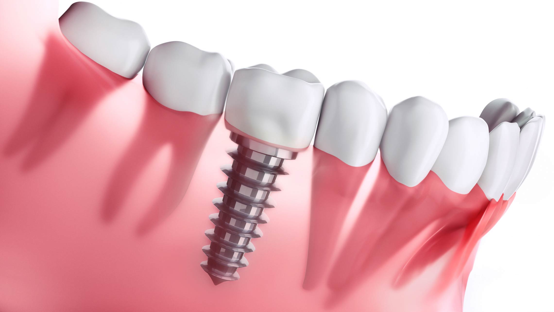 Implantoligia utile a sostituire un dente mancante