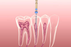 Endodonzia, conosciuta anche come cura canalare-Studio-odontoiatrico-Zedda-Settimo-San-Pietro