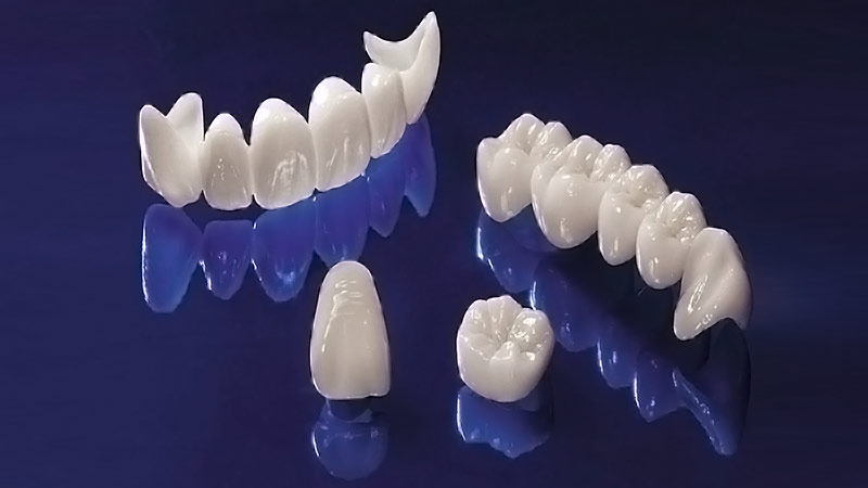 Esempi di protesi dentarie per riabilitazione protesica